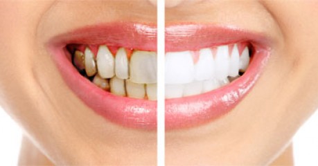 Periodontal Gum Treatment, Deep Cleaning