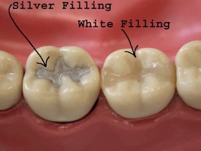 dental cavity filling
