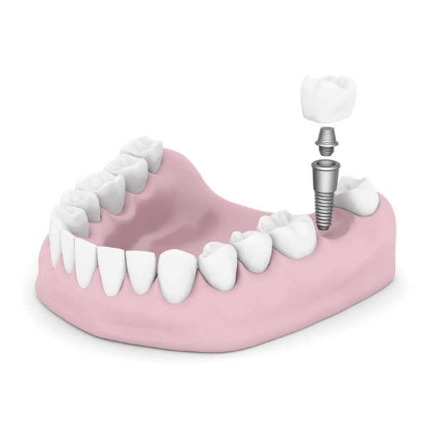 one day dental implants